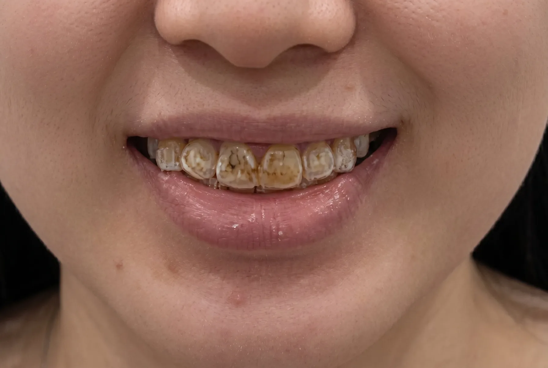 Smile Makeover - Before